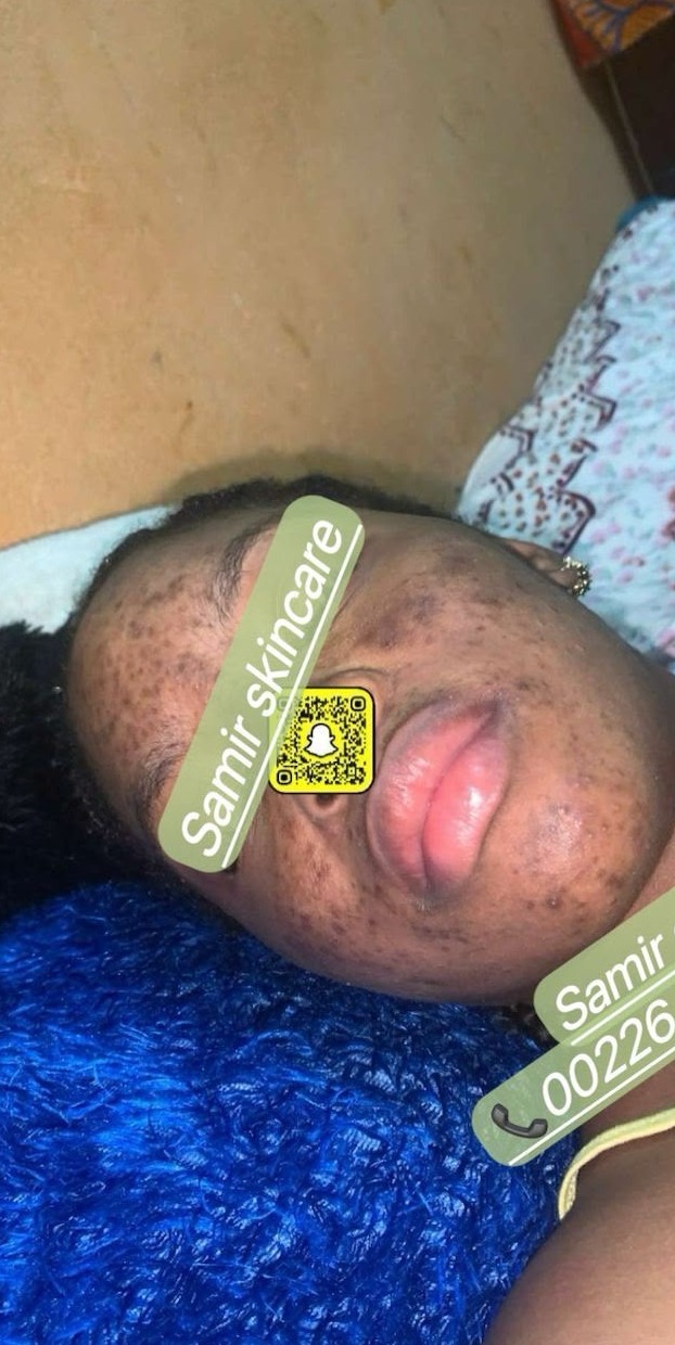 Avant les soins BIOCARE — Kadiatou Z., Kit visage anti-acné hormonal — 14 semaines