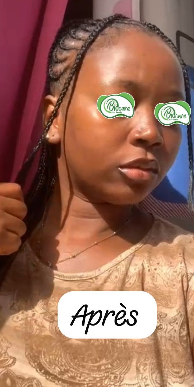 Après les soins BIOCARE — Fatou D., Kit visage anti-acné — 8 semaines