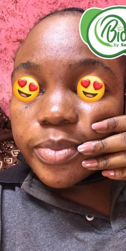 Avant les soins BIOCARE — Nafissatou T., Gamme Peau de luxe — 12 semaines