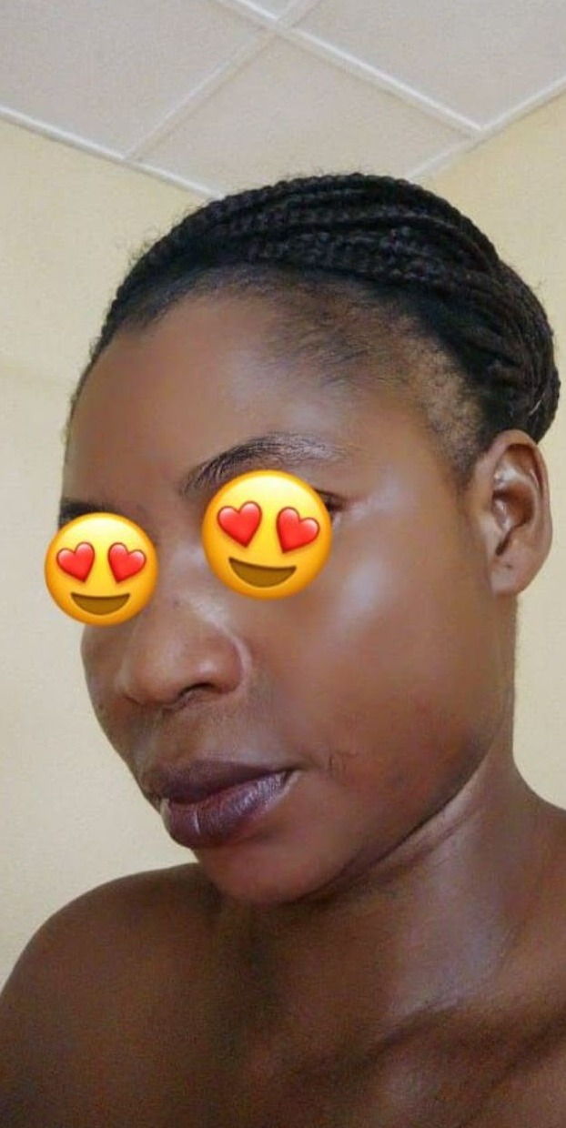 Après les soins BIOCARE — Aminata S., Gamme Hyperpigmentation — 12 semaines