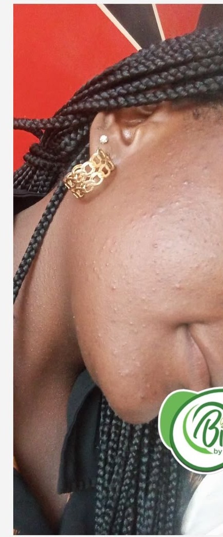 Avant les soins BIOCARE — Rachida B., Kit visage — 8 semaines