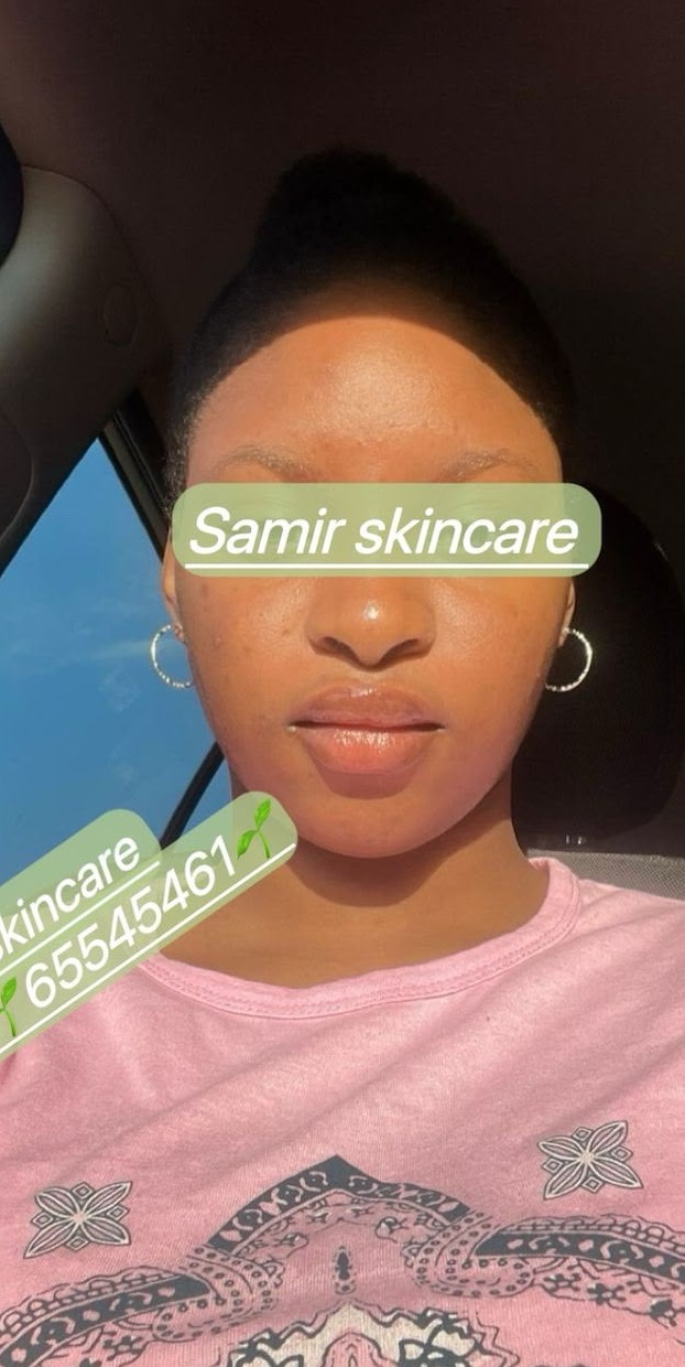 Après les soins BIOCARE — Kadiatou Z., Kit visage anti-acné hormonal — 14 semaines