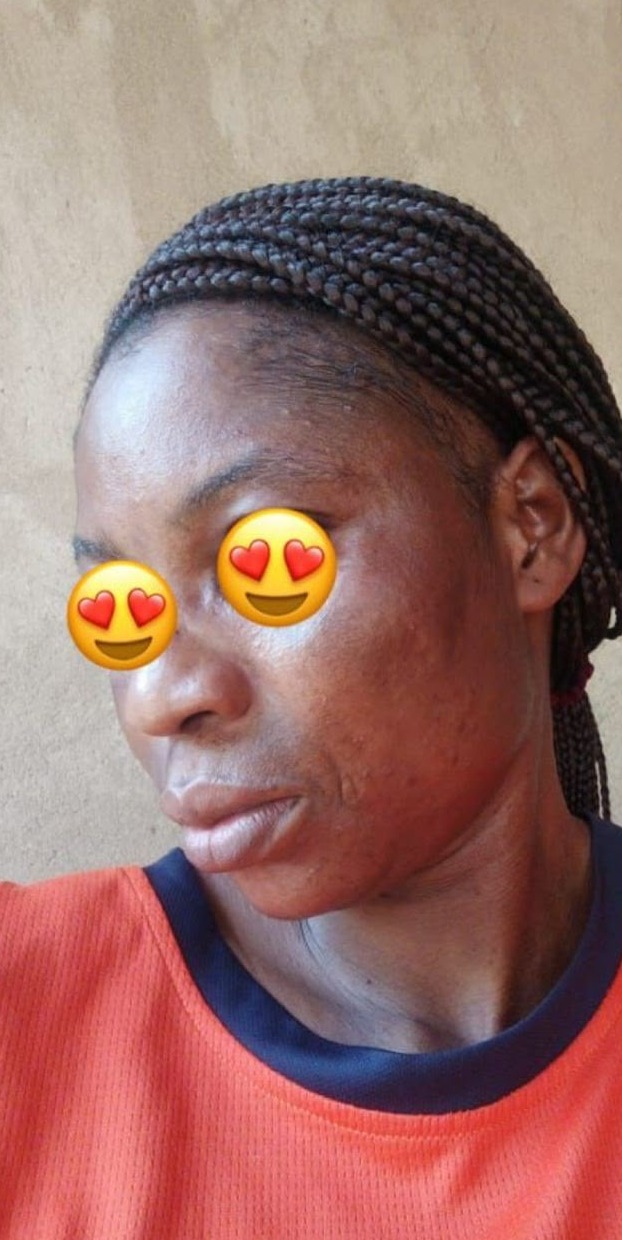 Avant les soins BIOCARE — Aminata S., Gamme Hyperpigmentation — 12 semaines