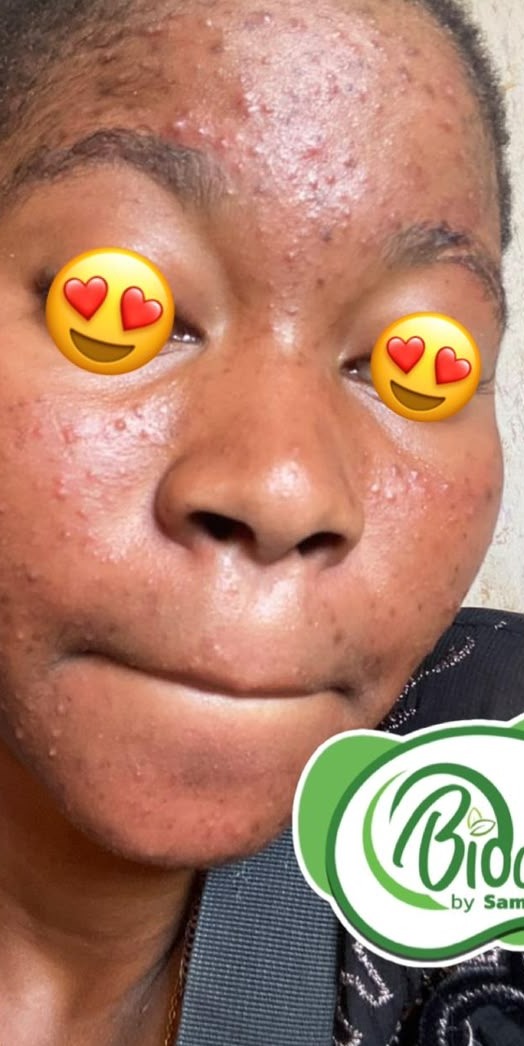 Avant les soins BIOCARE — Mariam K., Lotion réparatrice anti-taches — 10 semaines