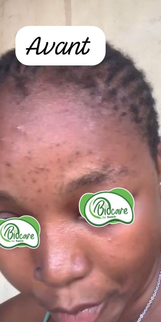Avant les soins BIOCARE — Fatou D., Kit visage anti-acné — 8 semaines